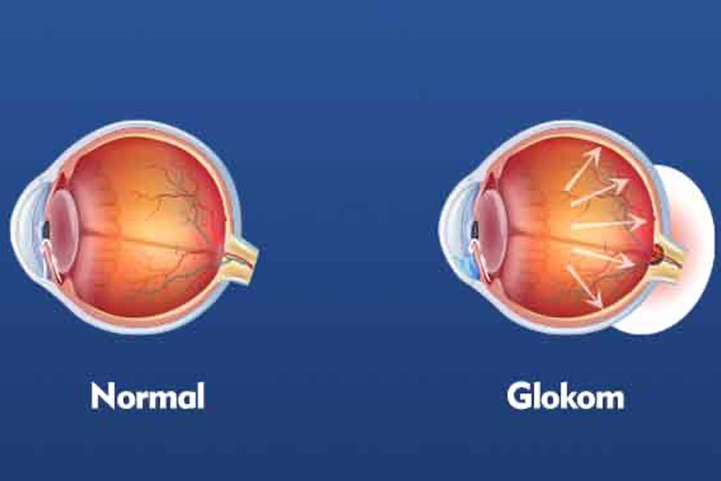 Glaucoma Surgery